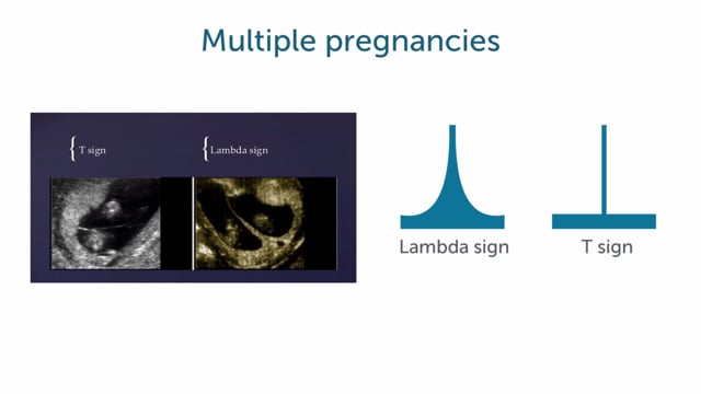 How do multiple pregnancies show in ultrasound?