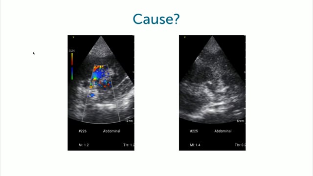 Case of a 22 y/o female with flank pain