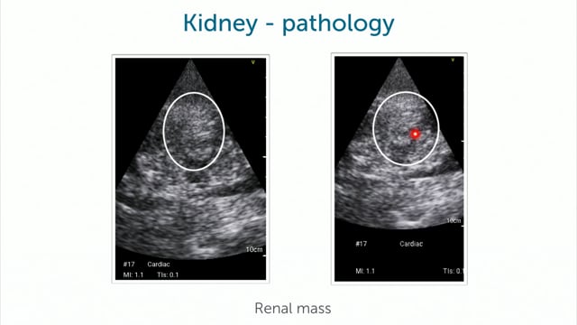 What kidney pathologies can I find with POCUS?