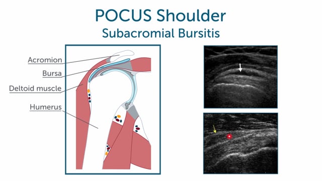 How can I scan for bursitis in the shoulder?