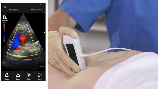 How does a AAA look in ultrasound?