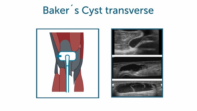 How can I view a Baker's cyst with ultrasound?