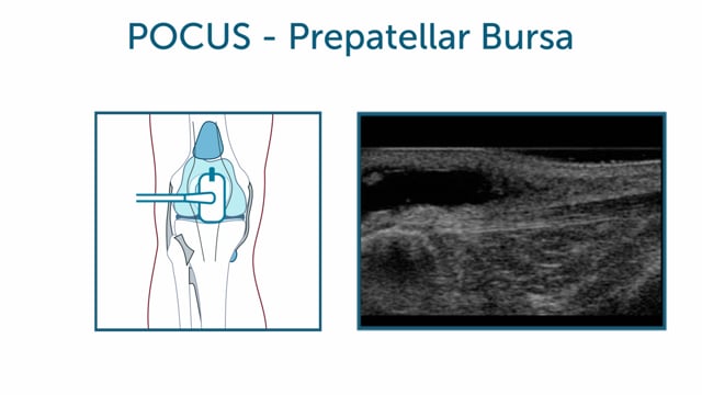 How can I view the knee's bursae?