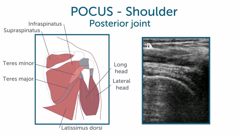 How can I scan the posterior shoulder?