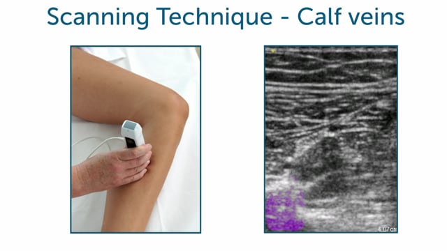 How can I scan the calf veins?