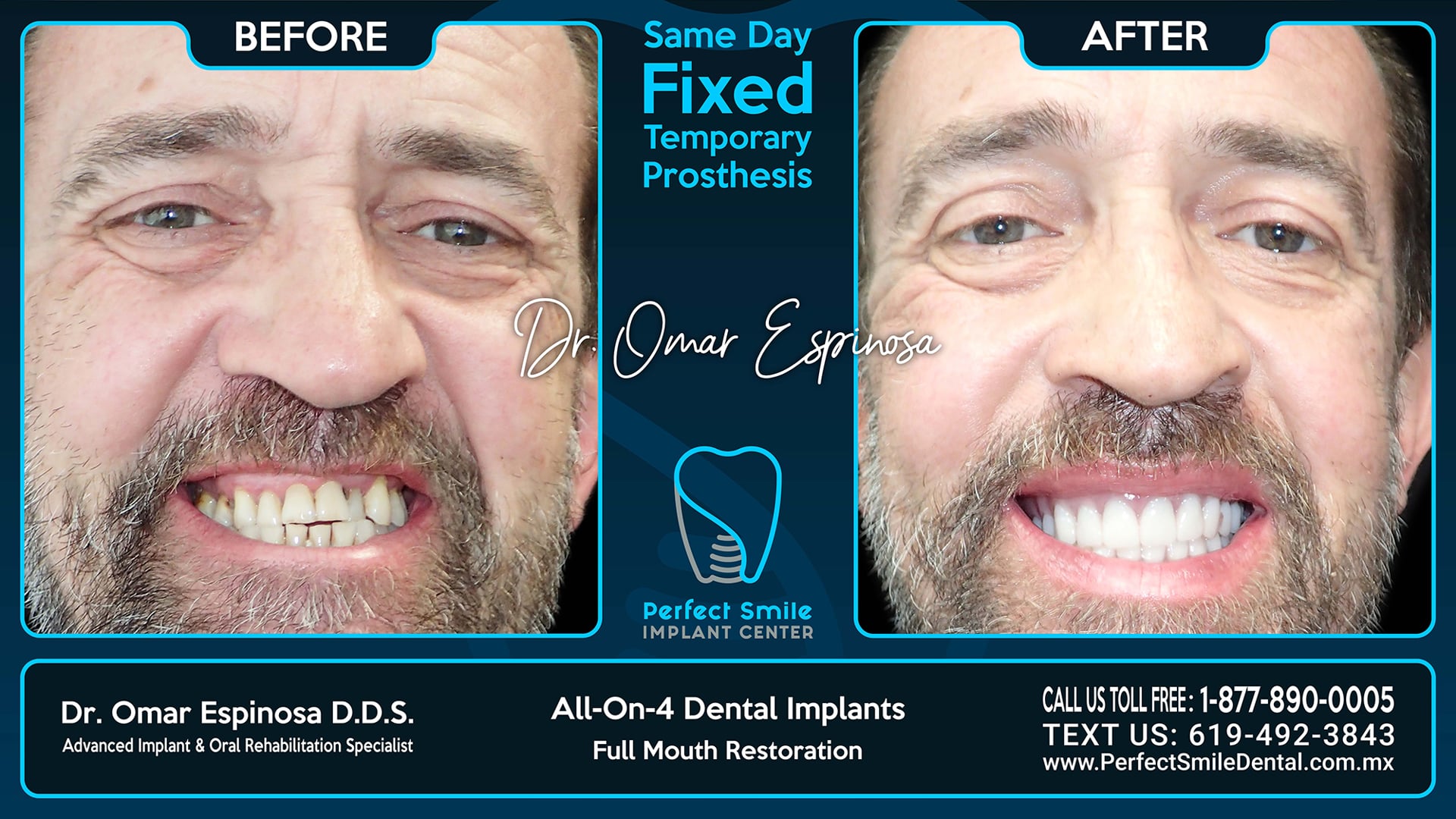 All On 4 Dental Implants Top & Bottom - Perfect Smile Implant Center - Tijuana, Mexico