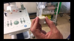 BIOPSIA PROSTÁTICA TRANSPERINEAL BAJO ANESTESIA LOCAL