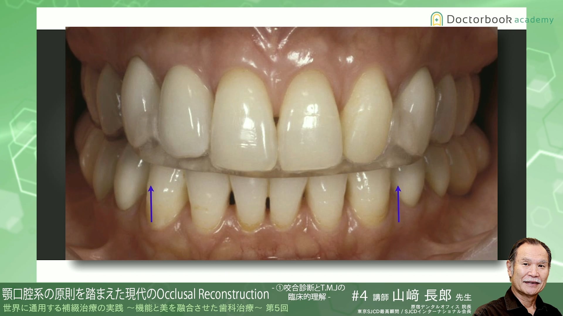 #4 咬合診断とT.M.Jの臨床的理解