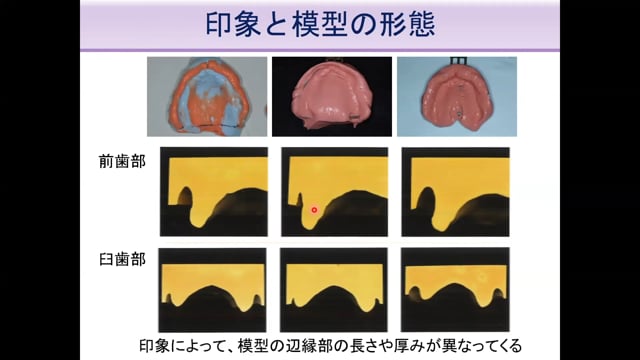 #2 Denture Cafe 第8回「BPSから学ぶ全部床義歯臨床の“肝”所 〜総論と概形印象〜」