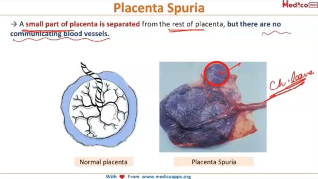 Placenta Spuria - www.medicoapps.org