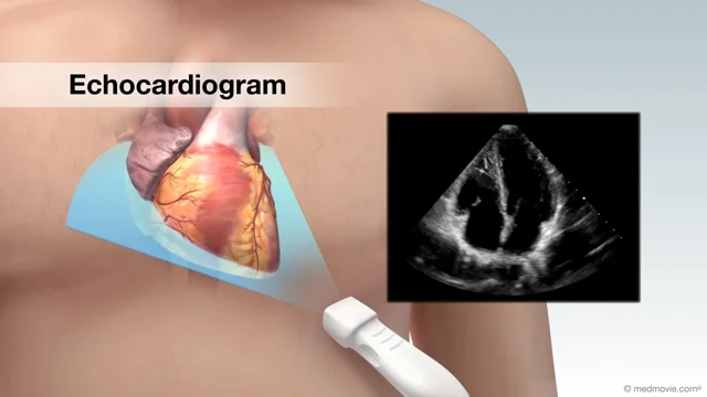 Echocardiogram Demonstration 