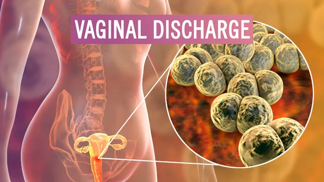 Vaginal discharge: What teenagers need to know - Graphic Online