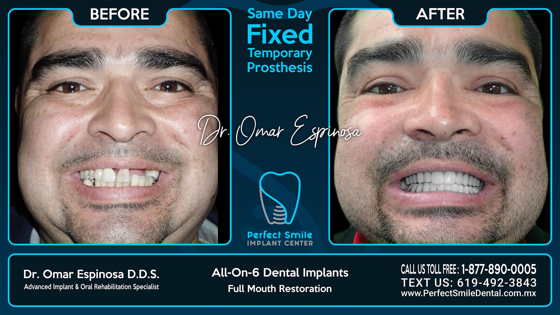 All On 6 Dental Implants Top & Bottom - Perfect Smile Implant Center - Tijuana, Mexico