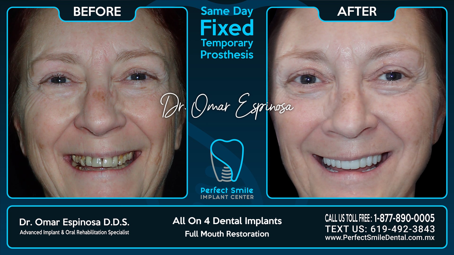 All On 4 Dental Implants Top & Bottom - Perfect Smile Implant Center - Tijuana, Mexico