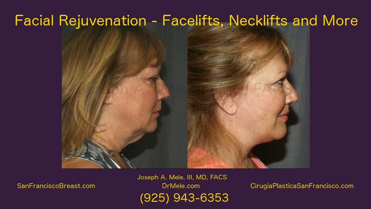 Necklift San Francisco Bay Area Walnut Creek, CA