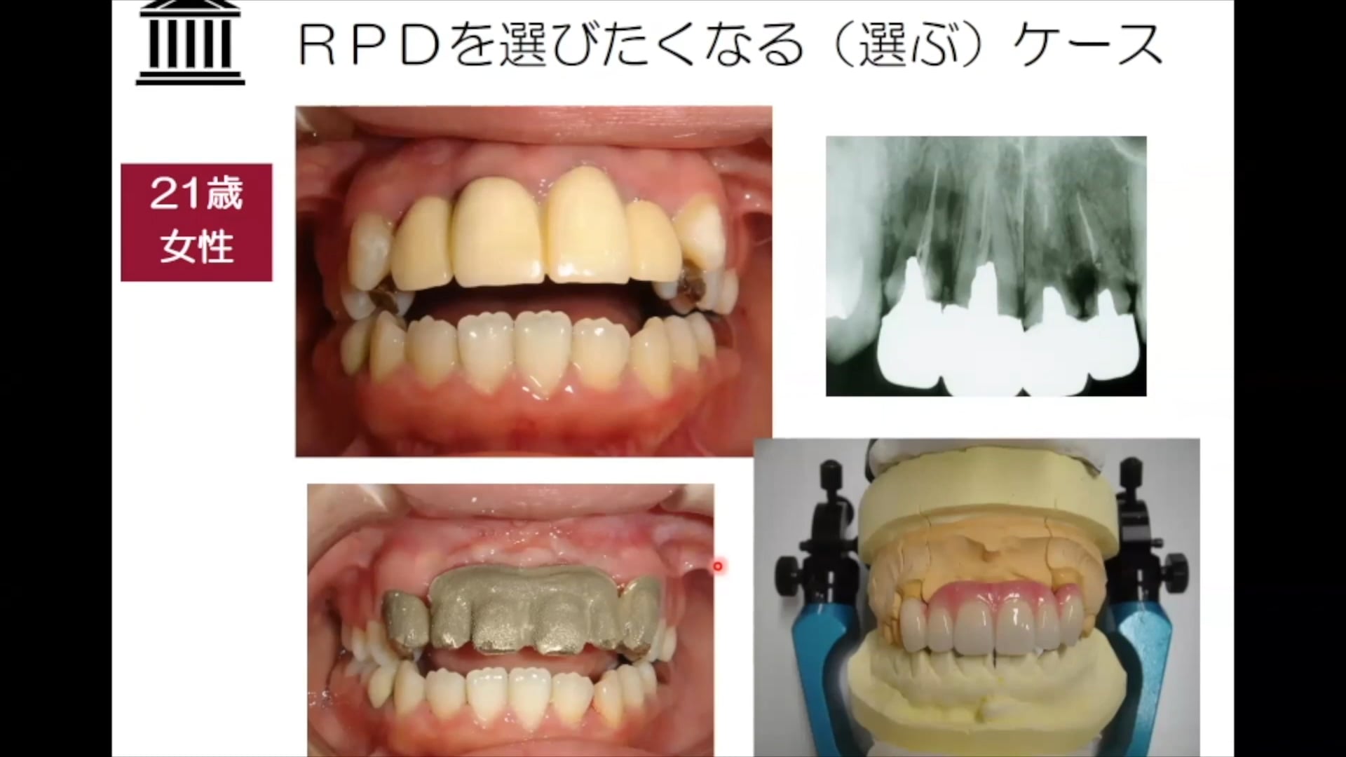 #1 Denture Cafe 第9回「少数歯中間欠損、ブリッジにするか？義歯にするか？ 〜選択基準を考えよう！〜」