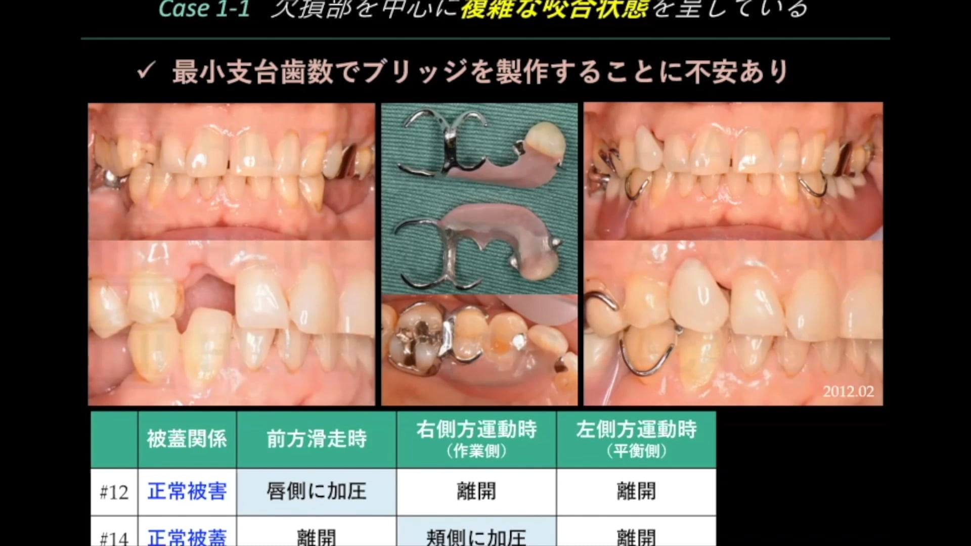 #2 Denture Cafe 第9回「少数歯中間欠損、ブリッジにするか？義歯にするか？ 〜選択基準を考えよう！〜」