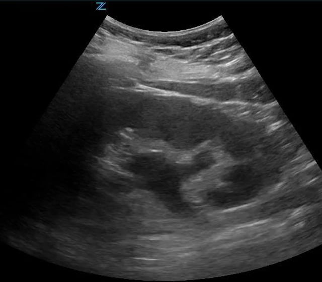 Normal Kidney Ultrasound