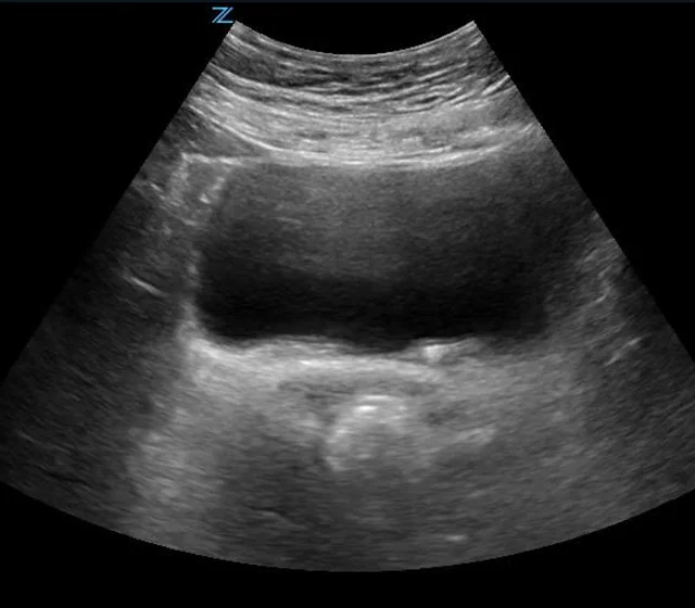 bladder stone ultrasound