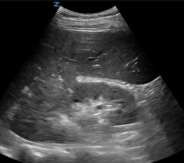 Chronic Pyelonephritis Ultrasound