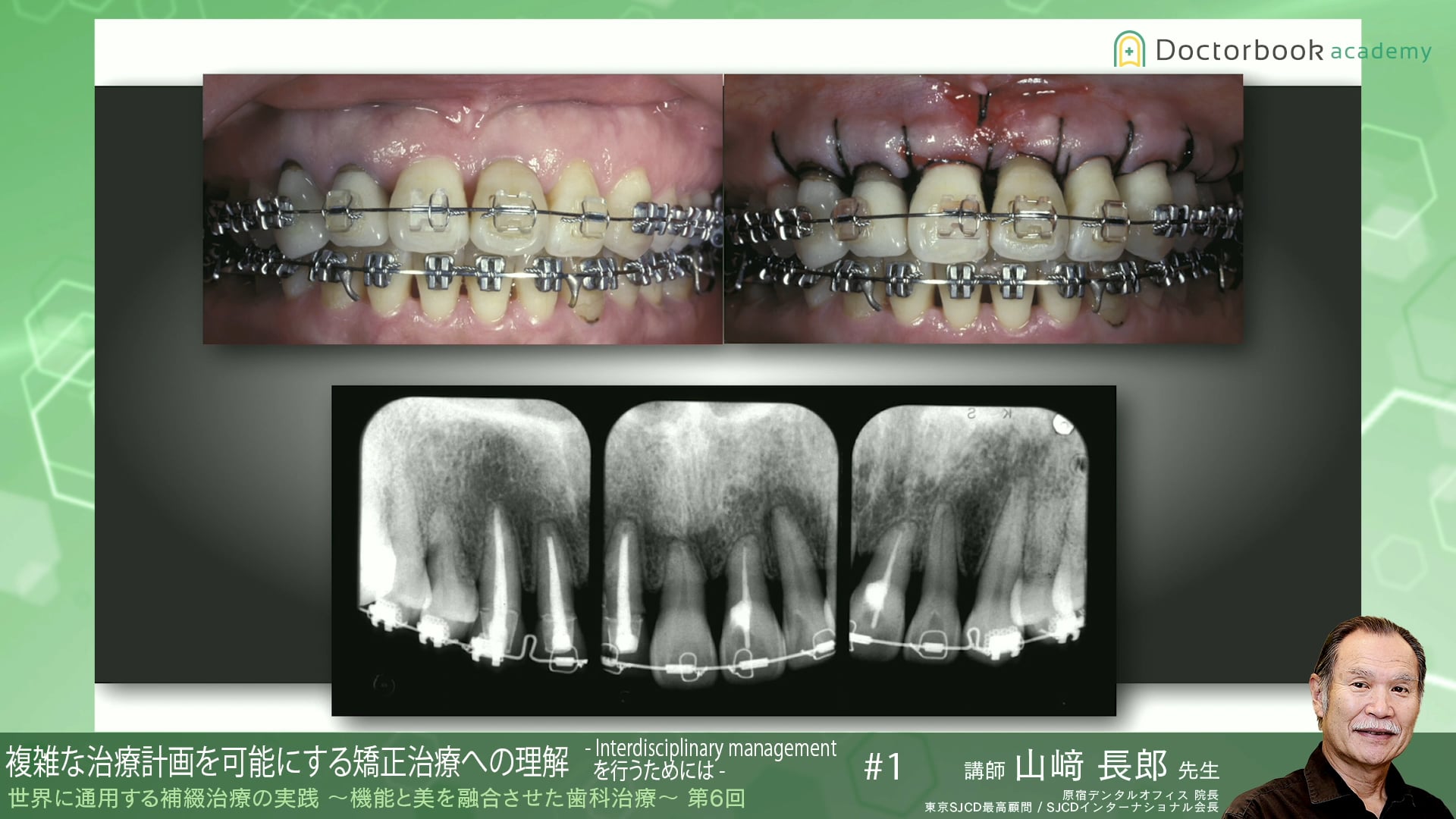 #5 複雑な治療計画を可能にする矯正治療への理解 -Interdisciplinary managementを行うためには-