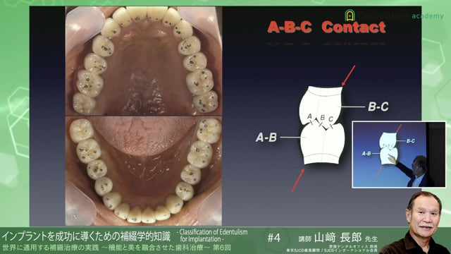 #4 インプラントを成功に導くための補綴学的知識 -Classification of Edentulism for Implantation-