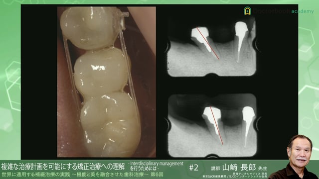 #6 複雑な治療計画を可能にする矯正治療への理解 -Interdisciplinary managementを行うためには-