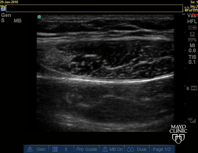 How To US View Rectus Muscle