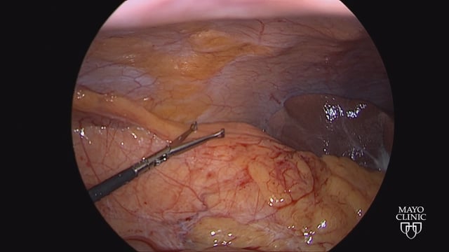 How to Transversalis Fascia Block 2