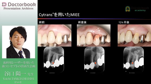 #3 MIEE：進化型Er-LBRT