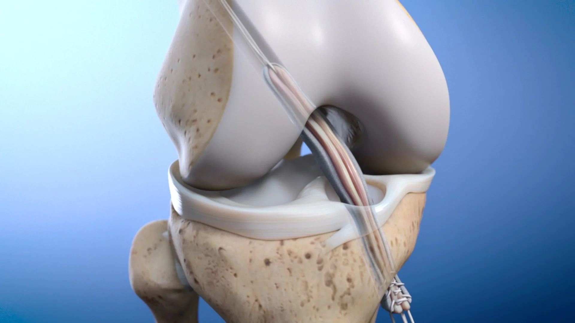 Reinforcing Tendon and Ligament Repair with BioBrace | XVIVO