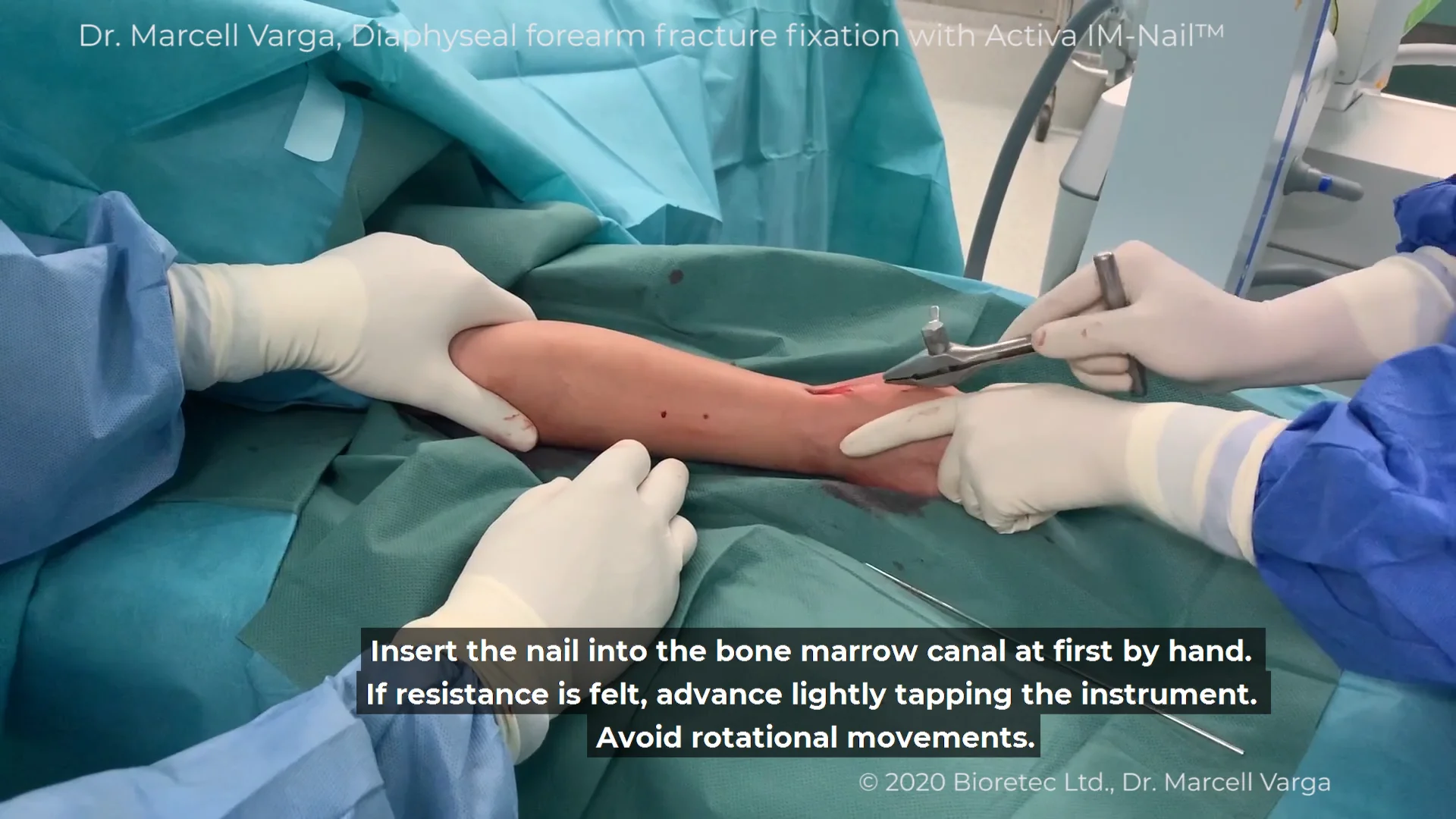 Intramedullary nailing of radius and ulna fracture with bioabsorbable Activa IM-Nail&trade; by Dr. Marcell Varga