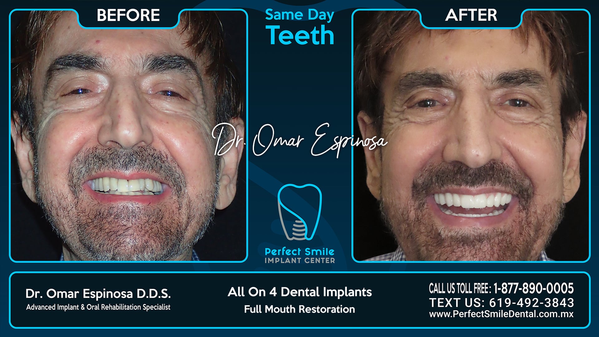All On 4 Dental Implants Top & Bottom - Perfect Smile Implant Center - Tijuana, Mexico