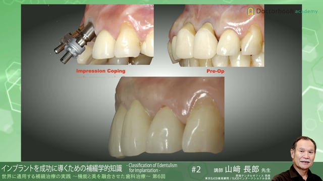 #2 インプラントを成功に導くための補綴学的知識 -Classification of Edentulism for Implantation-