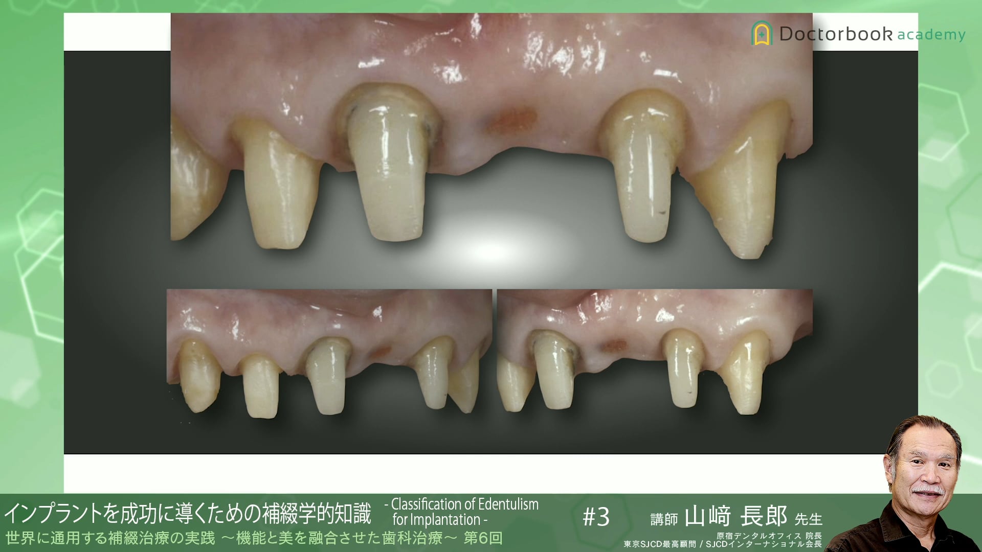 #3 インプラントを成功に導くための補綴学的知識 -Classification of Edentulism for Implantation-