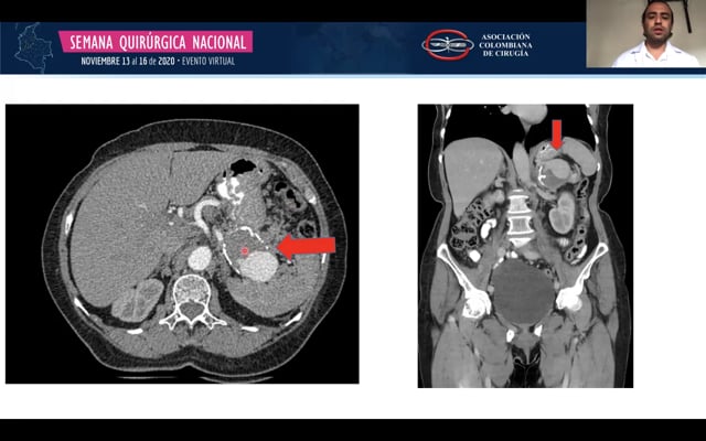 640px x 400px - Manejo de aneurismas de arterias viscerales - aneurisma de la arteria  esplÃ©nica - Insimeet