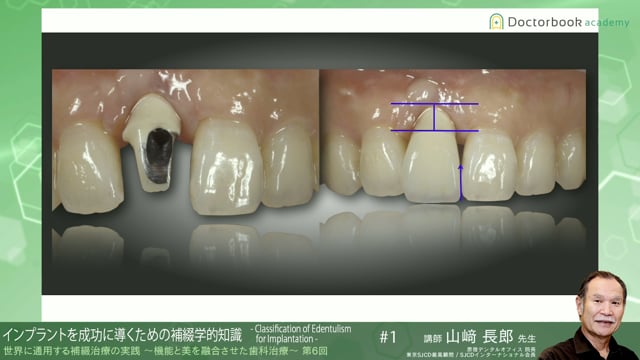 #1 インプラントを成功に導くための補綴学的知識 -Classification of Edentulism for Implantation-