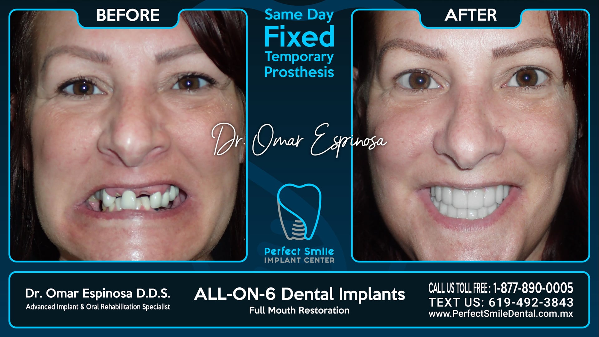 All On 6 Dental Implants Top & Bottom - Perfect Smile Implant Center - Tijuana, Mexico