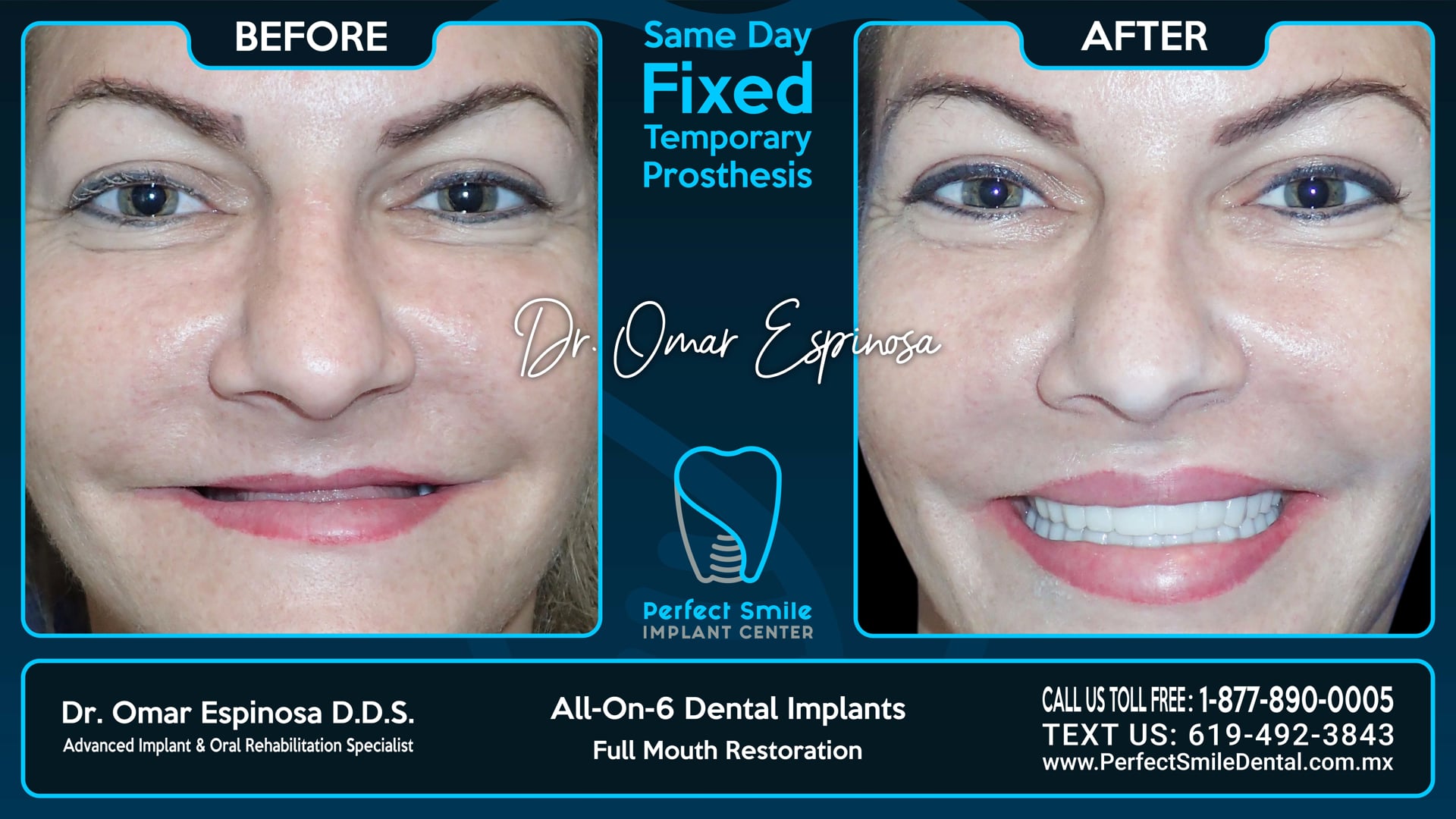 All On 6 Dental Implants Top & Bottom - Perfect Smile Implant Center - Tijuana, Mexico