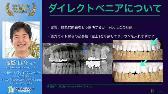 【第2回ケースレポートGP】NO.3	高橋 良介先生「”プレモールド インジェクションべニア”テクニックの提案　～誰にでも取り組める審美・機能改善のためのダイレクトボンディング～」