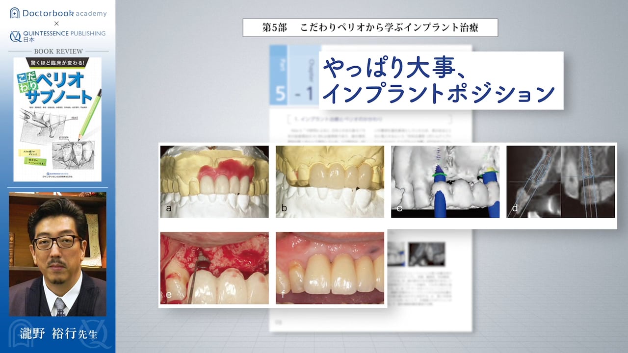 #2 こだわりペリオから学ぶインプラント治療