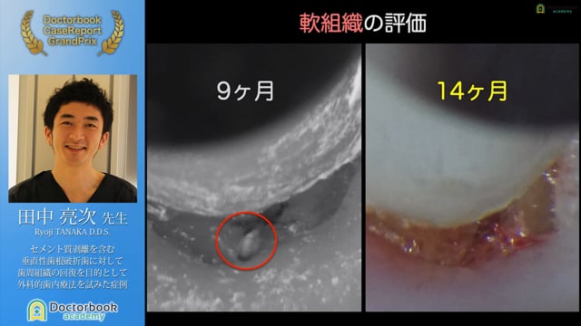 【第2回ケースレポートGP】NO.6	田中 亮次先生「セメント質剥離を含む垂直性歯根破折に対して歯周組織の回復を目的として外科的歯内療法を試みた症例」