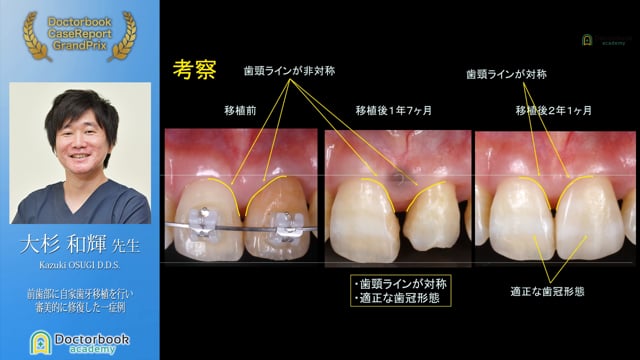 【第2回ケースレポートGP】NO.4	大杉 和輝先生「前歯部に自家歯牙移植を行い審美的に回復した一症例」