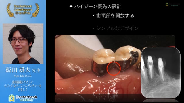 【第2回ケースレポートGP】NO.1 飯田 雄太先生「歯周組織にやさしいリジッドなパーシャルデンチャーを目指して」