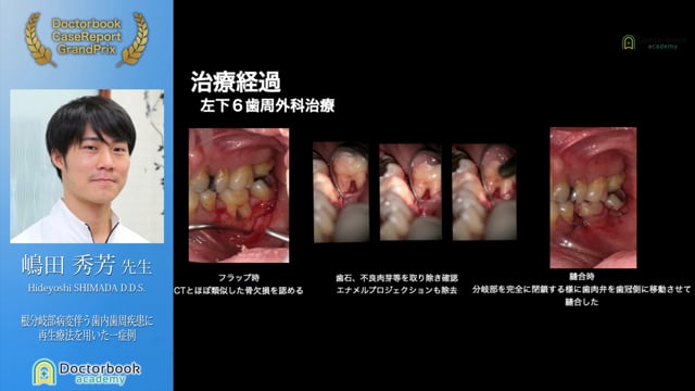 【第2回ケースレポートGP】NO.2	嶋田 秀芳先生「根分岐部病変伴う歯内歯周疾患に再生療法を用いた一症例」