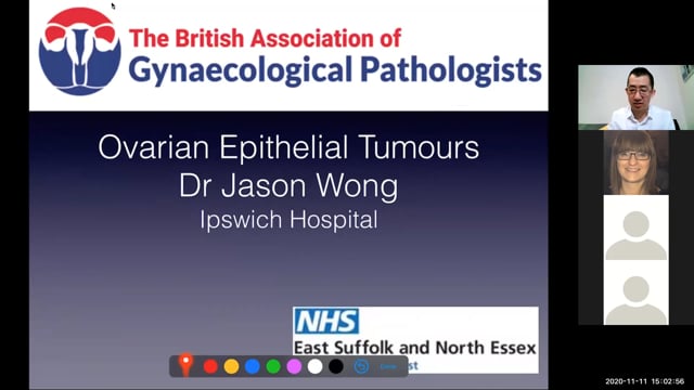 Introduction to Ovarian epithelial tumours
