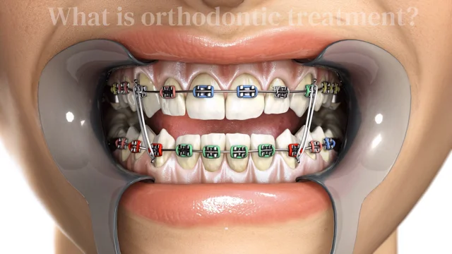 Dramatic Improvement After Early Orthodontic Treatment